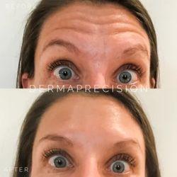 Forehead lines - result