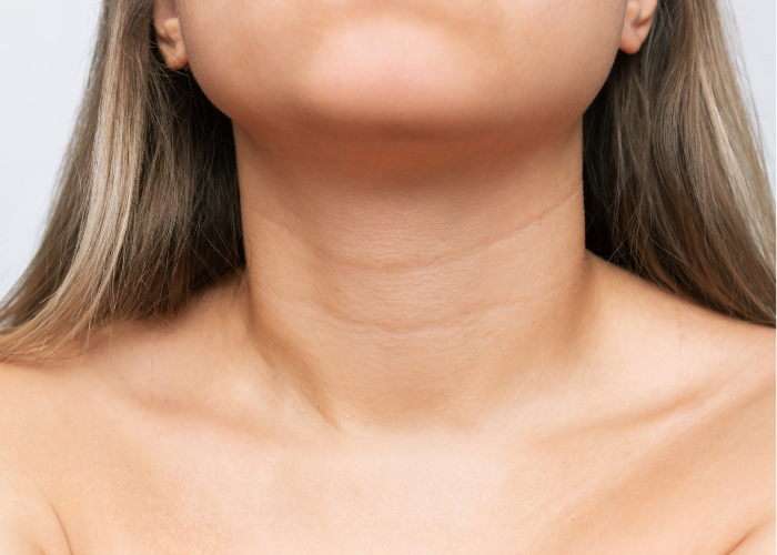 Platysmal Bands Neck Lines