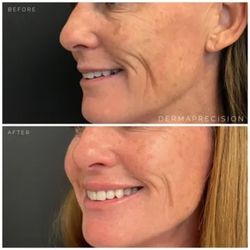 Sculptra Result for Fine lines