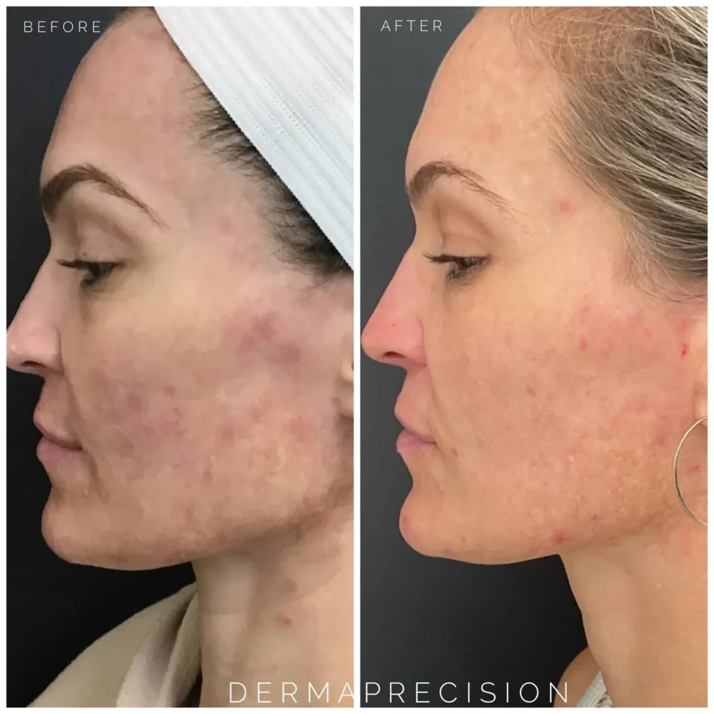 Vivace Ultra Microneedling Treatment