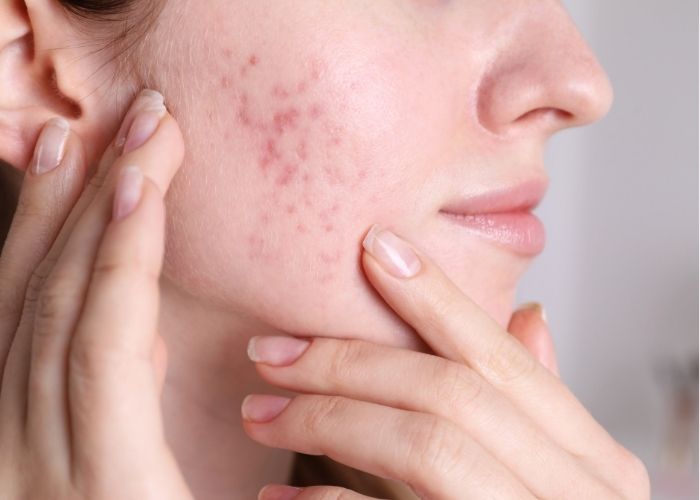 Acne Scars