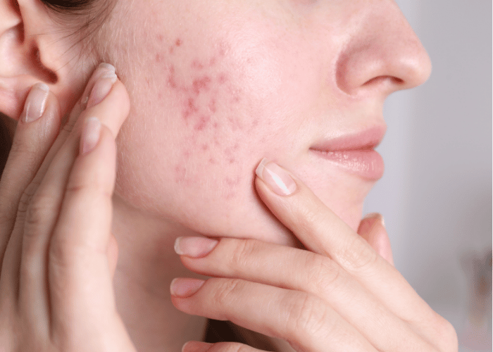 Acne and acne scars