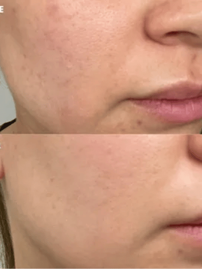 BioRePeel Treatment