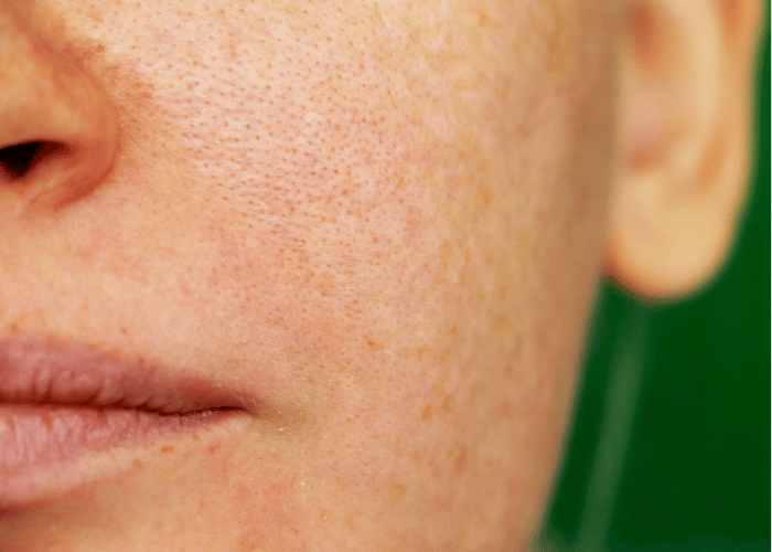 Enlarged pores