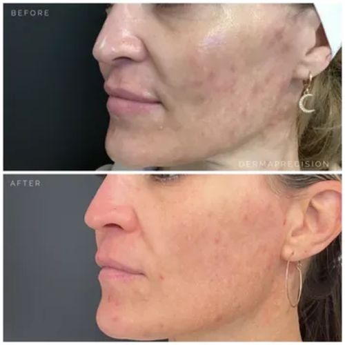 Full face_acne scarring