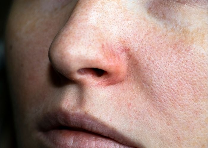 Large Pores