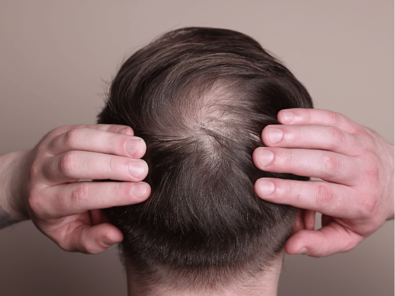 Male and Female Pattern Baldness