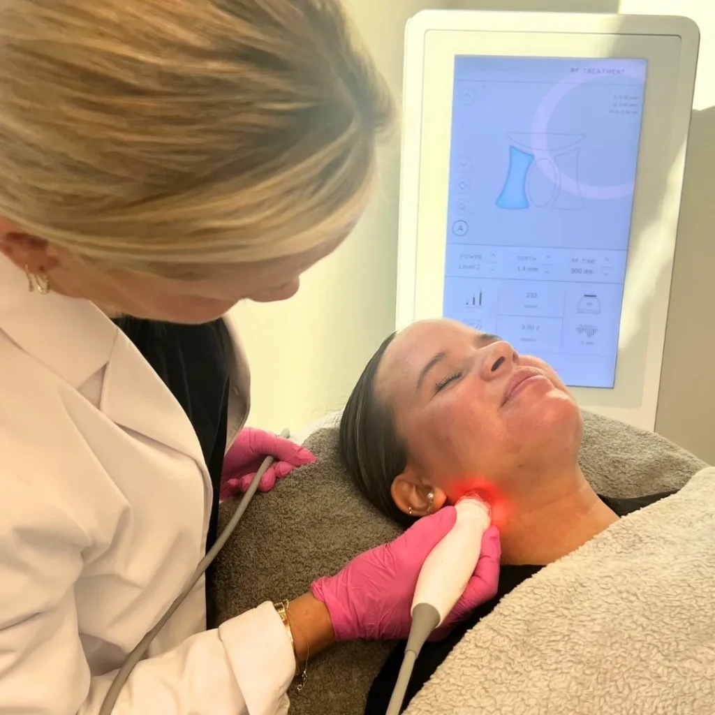 Radiofrequency microneedling