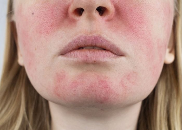 Rosacea