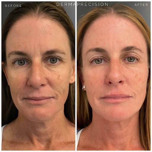 Makes-Sculptra-derma