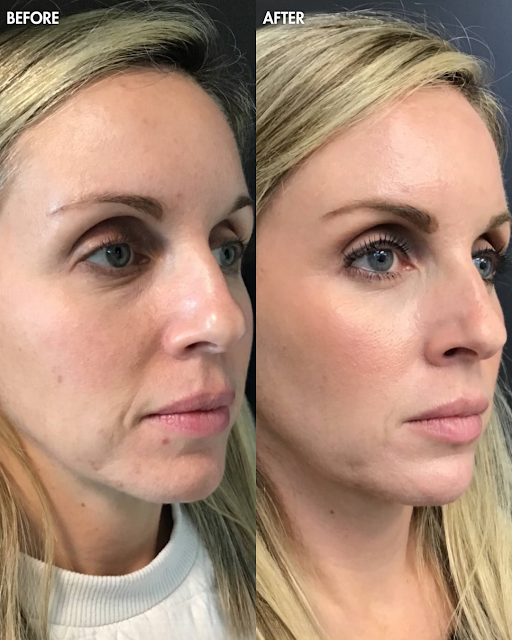Makes-Sculptra