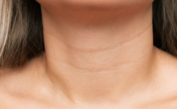 Platysmal Bands (Neck Lines)