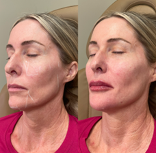 What Is Facial Balancing