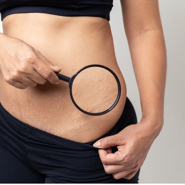 What is Stretch marks