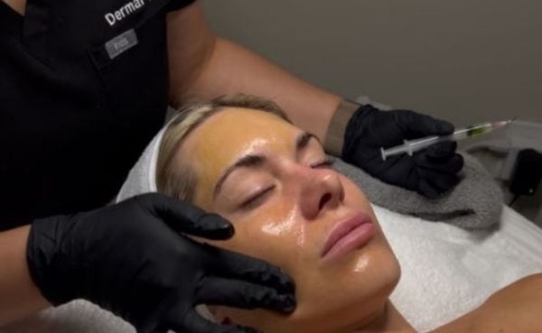BioRePeel Chemical Peel