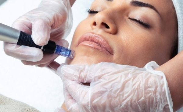 Vivace Ultra RF Microneedling